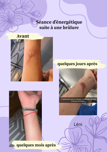 HarmonyEnergetic_brûlure _mahnétisme